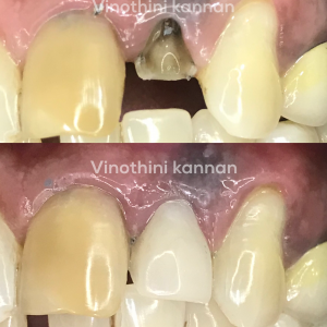 Tooth Replacement