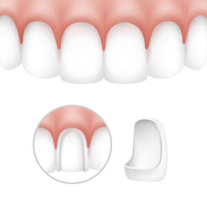dental veneers treatment in seawoods