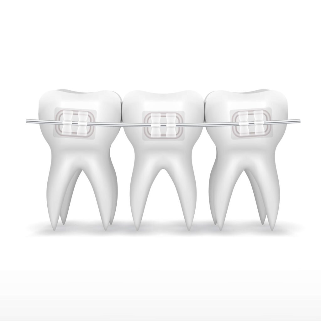 Braces Treatment in Seawoods