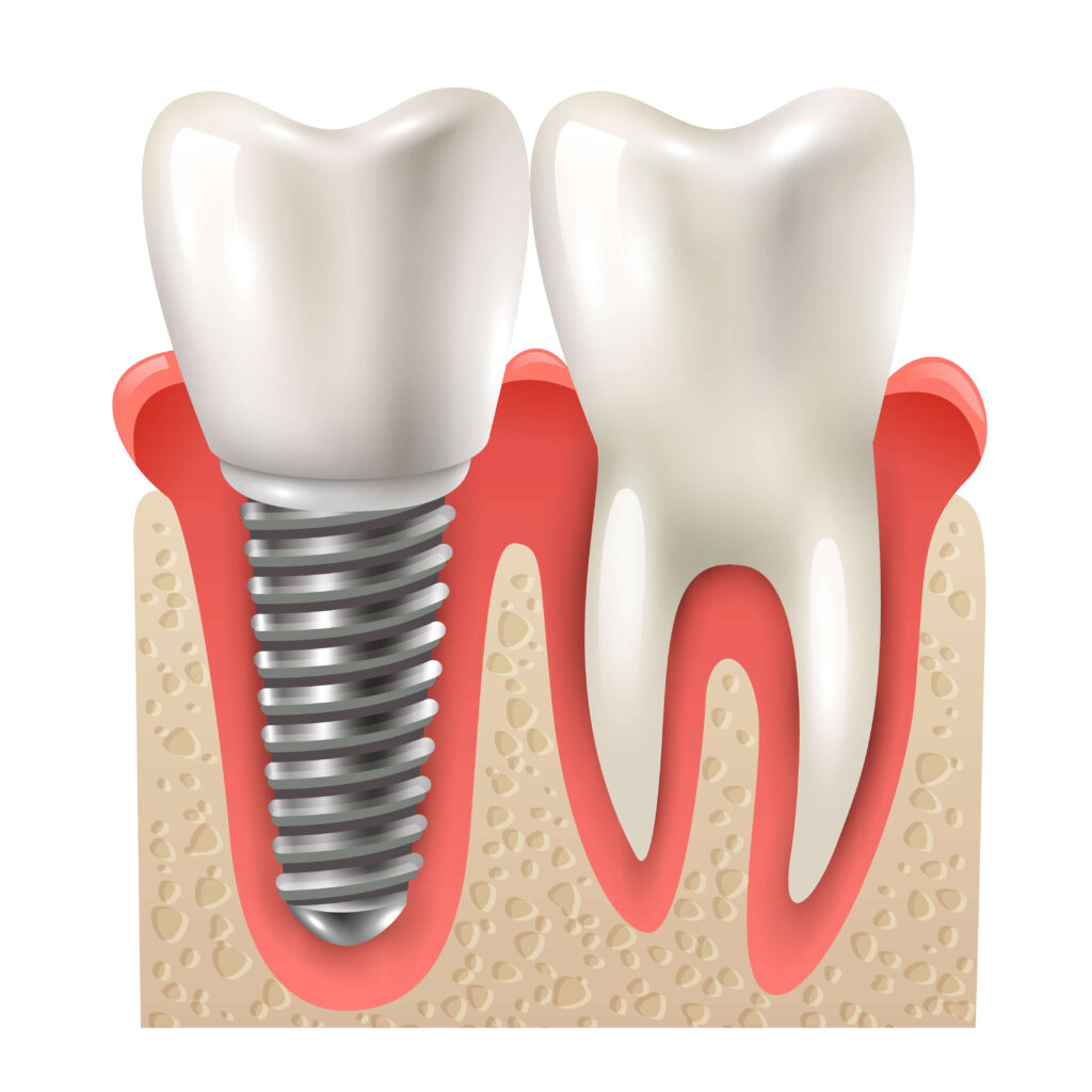 Dental Implants Cost in Seawoods