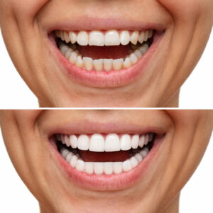 teeth whitening in seawoods