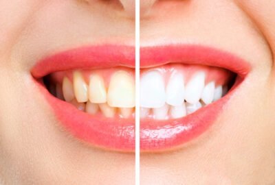 Professional Teeth Whitening Treatments in Seawoods
